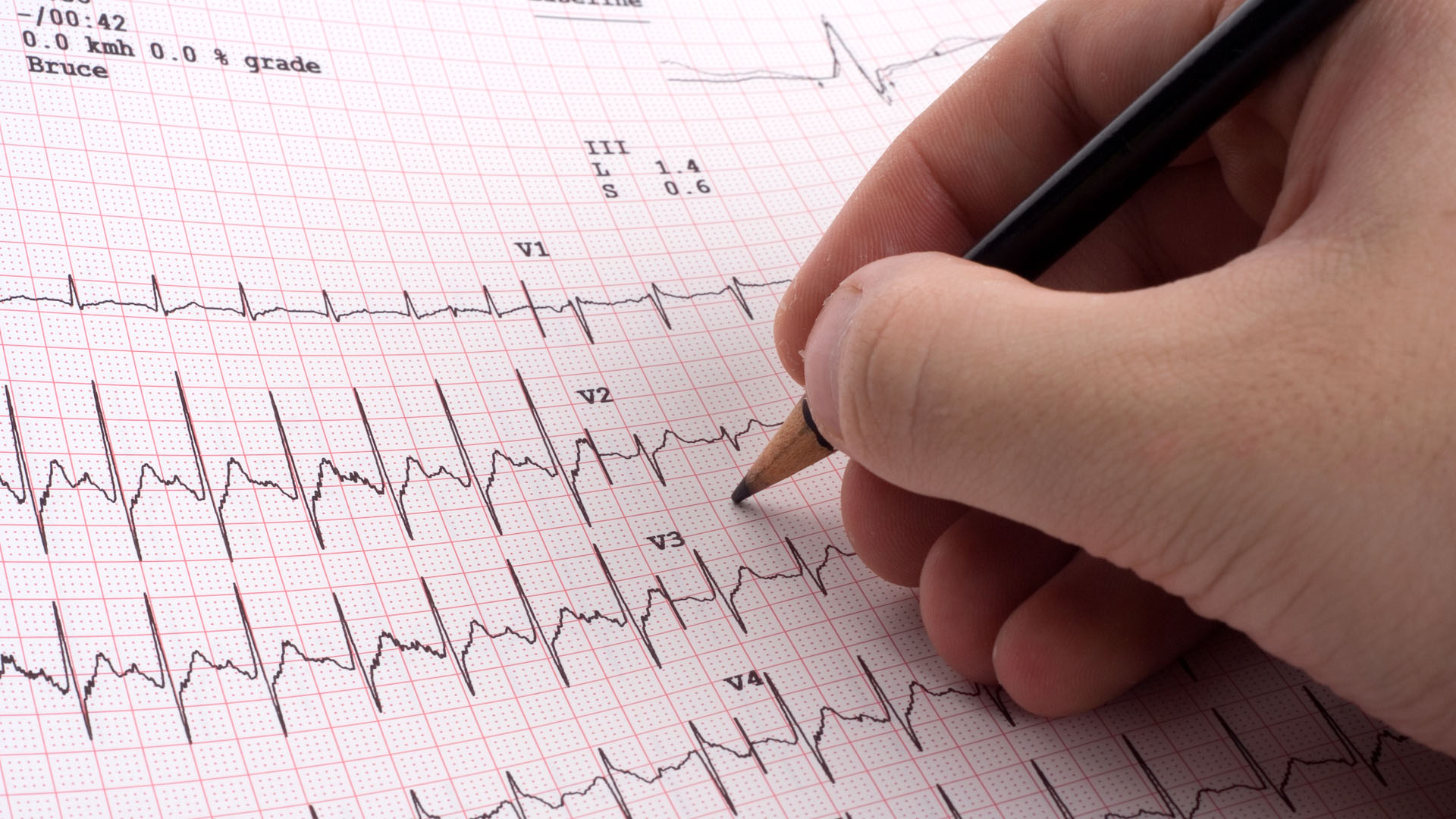 decoding-ekg-basics-a-comprehensive-guide-for-aspiring-monitor-techs